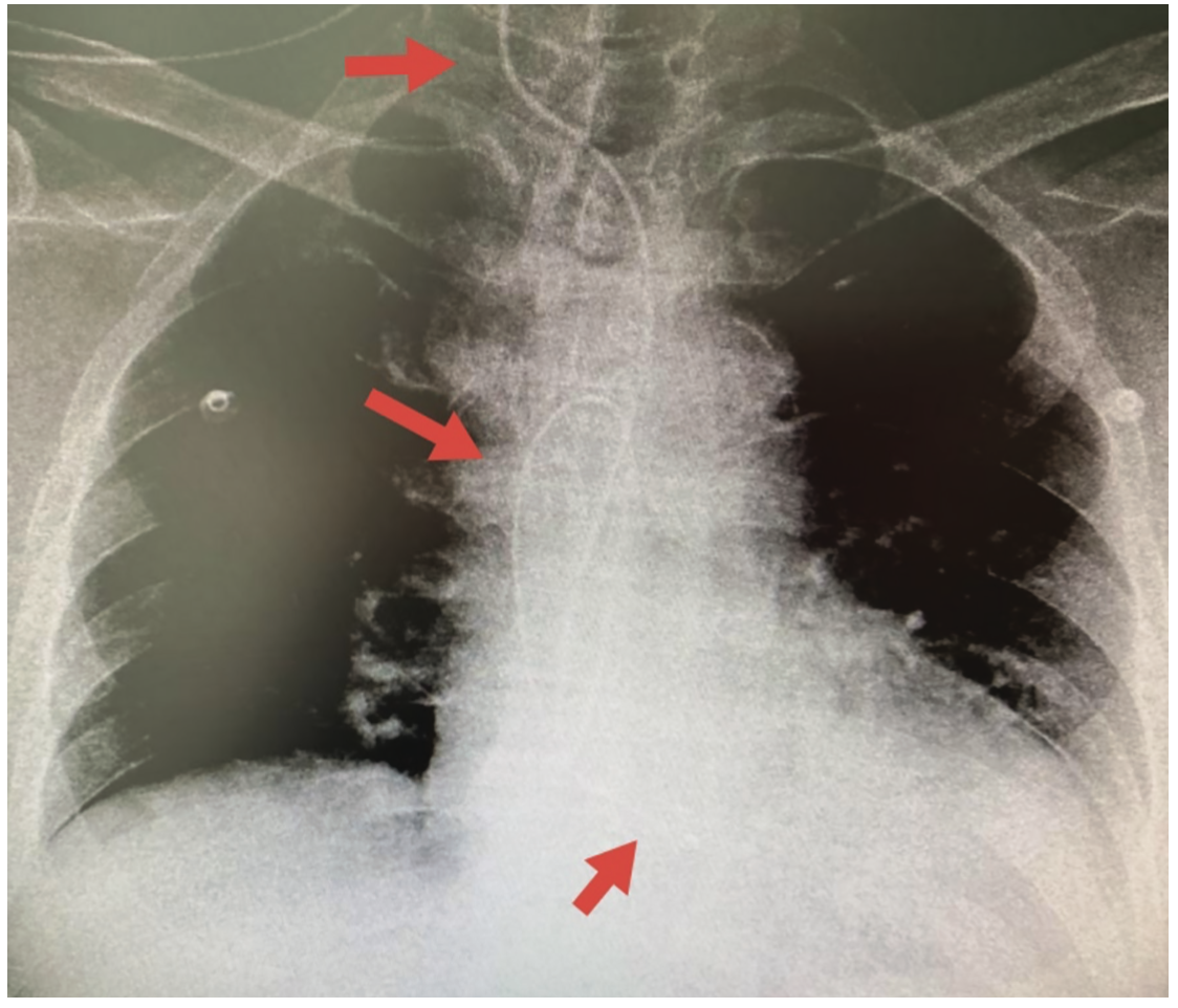 Inadvertent Transarterial Temporary Pacemaker Lead Placement An Unusual Complication